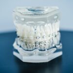 Lightforce 3D Printed Braces