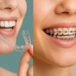 is Invisalign Suitable for You