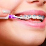 food-stuck-in-braces