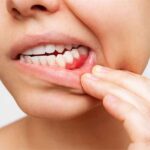 Bleeding Gums While Wearing Braces