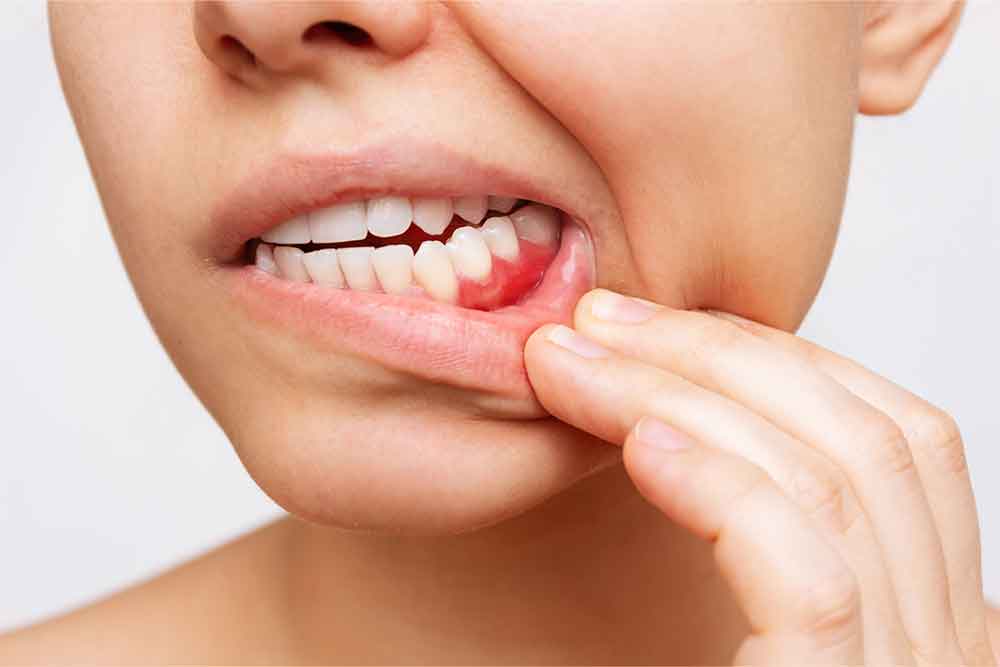 Bleeding Gums While Wearing Braces
