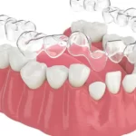 Guess the Number of Clear Aligners in our Cookie Jar