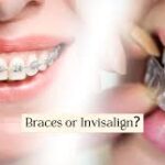 How I Decide if Braces or Invisalign is Better For You