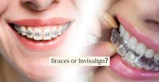 How I Decide if Braces or Invisalign is Better For You