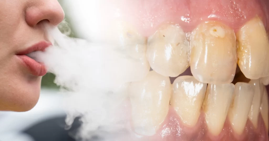 The Oral Health and Orthodontic Dangers of Vaping