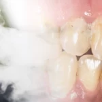 The Oral Health and Orthodontic Dangers of Vaping