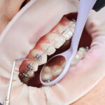 Are Orthodontics Procedures Overseas Safe?