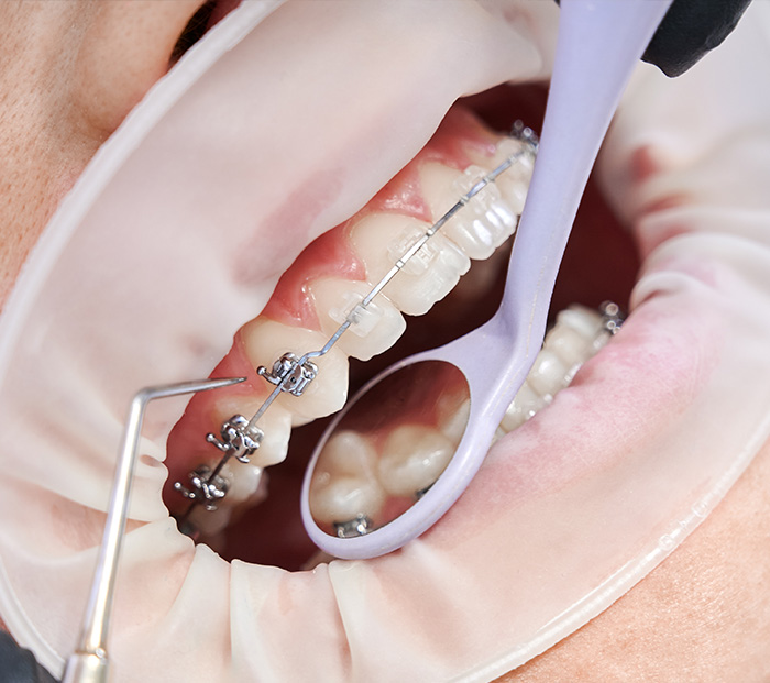 Are Orthodontics Procedures Overseas Safe?