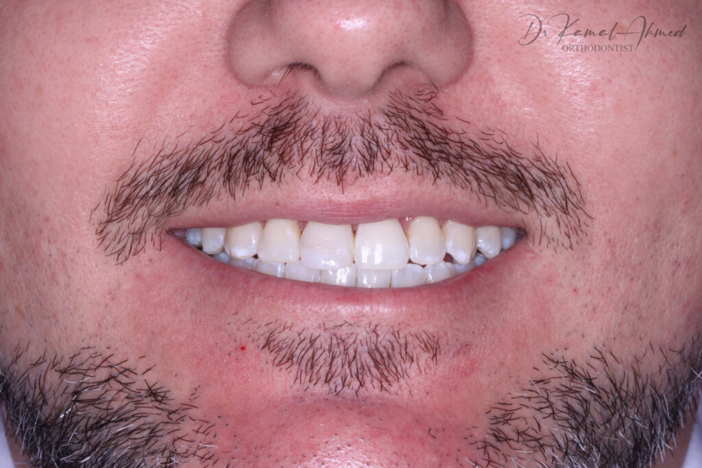 James’ Journey to a Better Smile - After