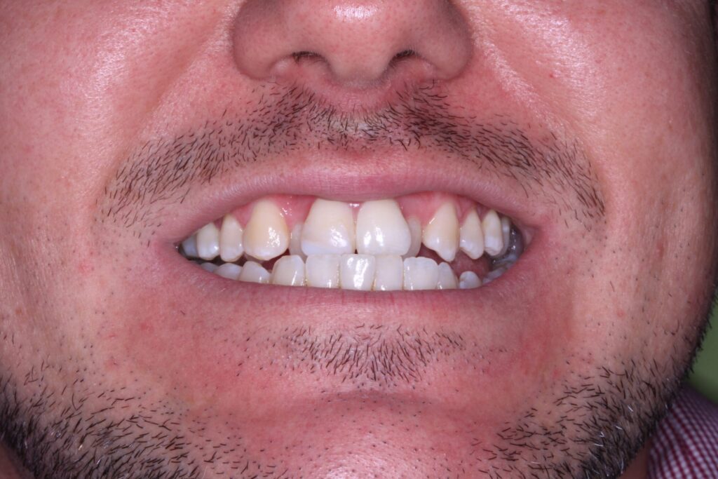 James’ Journey to a Better Smile - Before